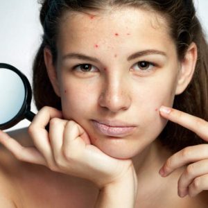 Does Collagen Help With Acne?