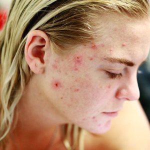 Can Moisturizer Cause Acne?