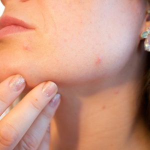 Does Botox Help Acne?